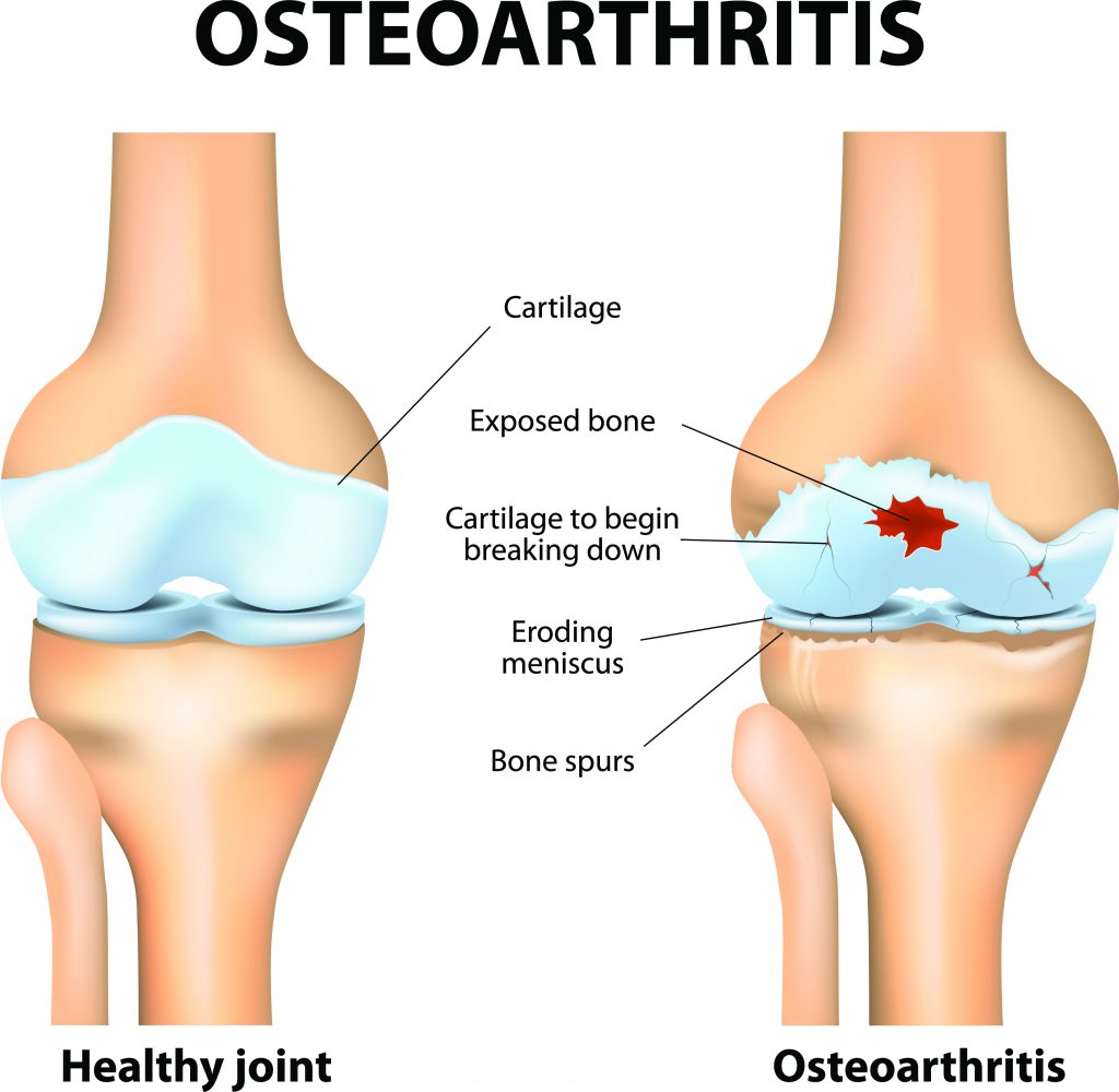 végtag osteoarthritis
